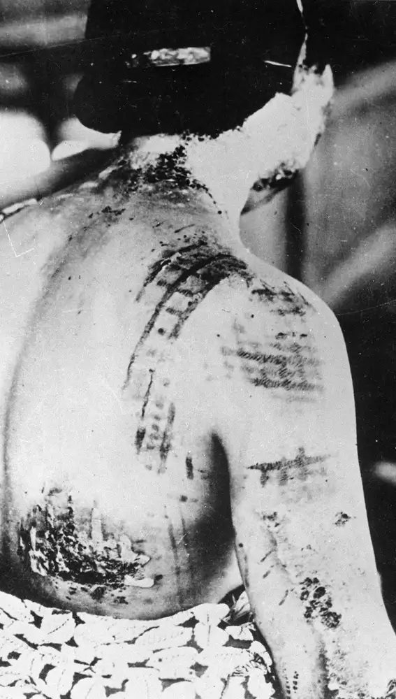 Mujer afectada por la bomba atómica