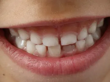 Dientes Dientes
