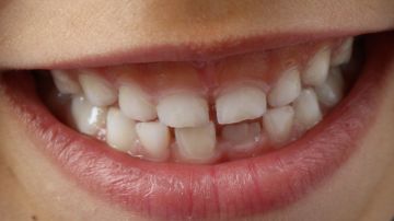 Dientes